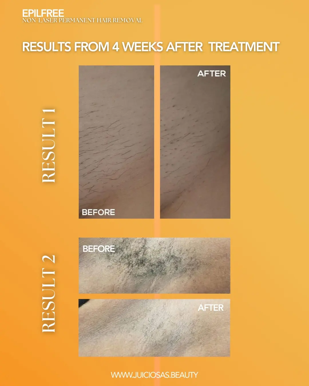 Before and after EpilFree hair reduction results